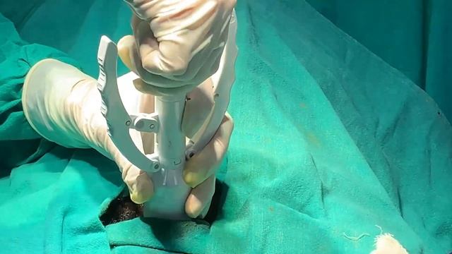 Zsr Circumcision For Phimosis | Live Surgery And Other Details