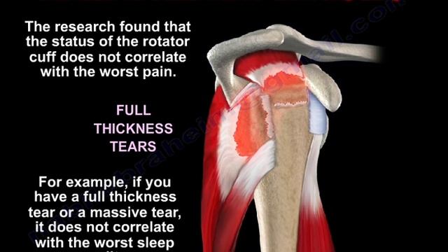 Rotator Cuff Symptoms Sleep Disorders - Everything You Need To Know - Dr. Nabil Ebraheim смотреть онлайн