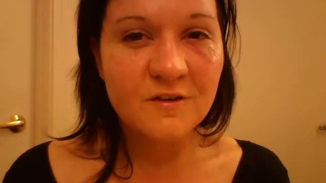 Day 2 after "Lay Lift" Slim Lipo contouring and Fat Grafts смотреть онлайн