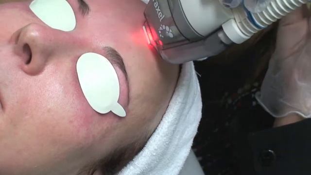 Fraxel Laser re:store for Face смотреть онлайн