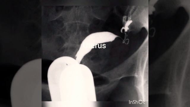 unicornuate uterus on hsg(infertility, ectopic pregnancy, repeated miscarriage)#shorts #infertility смотреть онлайн