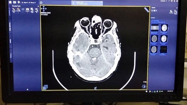 Brain Hemorrhage, Bleeding with Brain смотреть онлайн
