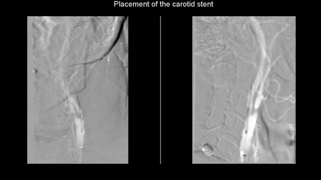 Endovascular Treatment Of Internal Carotid Artery Stenosis Via Placement Of Carotid Stent