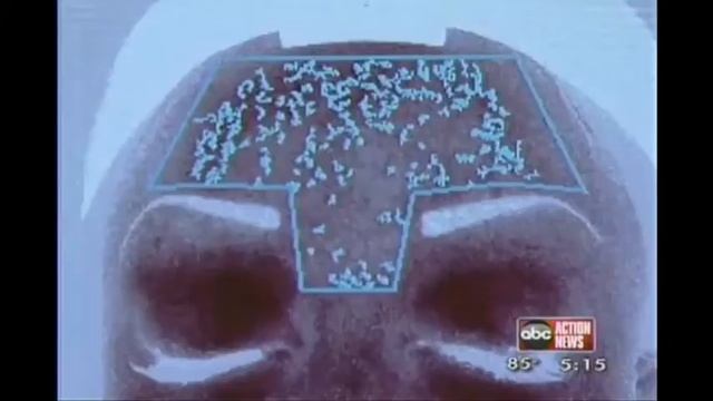 MiXto SX Fractional CO2 (MEDICI-H) смотреть онлайн