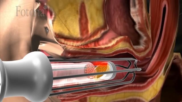 Incontilase - Incontinencia Urinaria смотреть онлайн