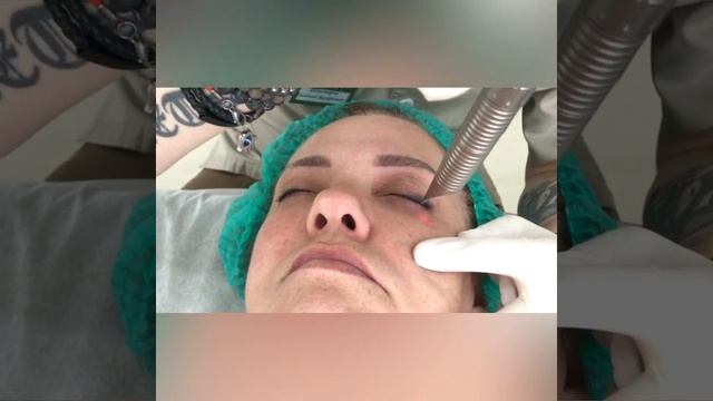 Smooth Eye Fotona Lasers смотреть онлайн