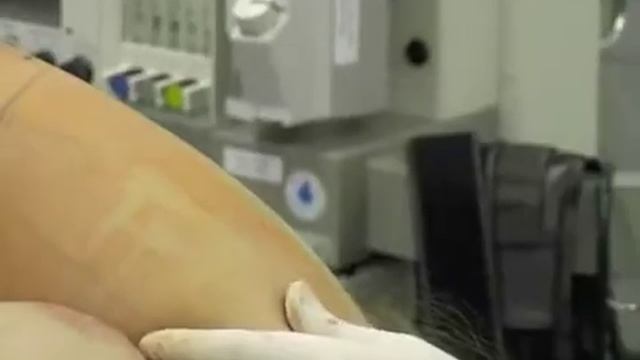 Липосакция плеча смотреть онлайн