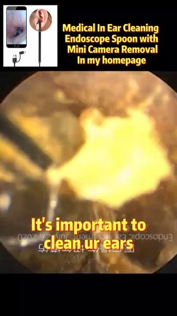 Best Ear Wax Removal & Extraction with Vacuum Remover 真空リムーバーによるにきびの除去と抽出 162 смотреть онлайн