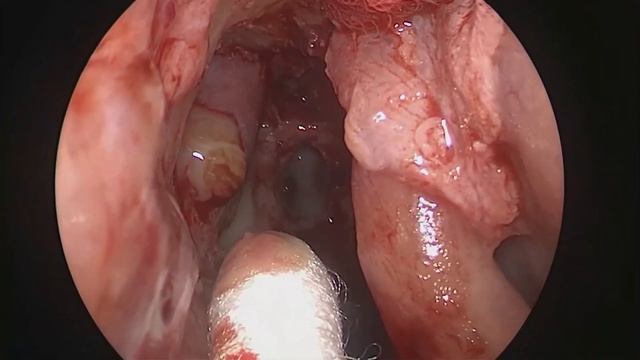 Эндоназальная дакриоцисториностомия смотреть онлайн