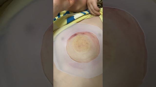 21-й день ношения вакуумного колокола. смотреть онлайн