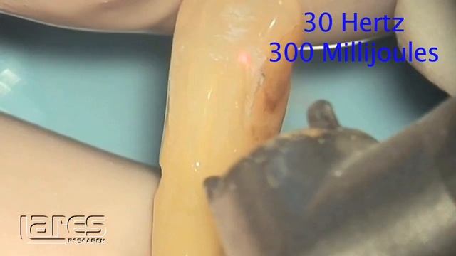 Dental Laser Hertz Studies - Dr. Robert Barr - Lares Dental смотреть онлайн
