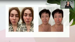 Убираем носогубные складки. Бесплатное занятие. Запись прямого эфира