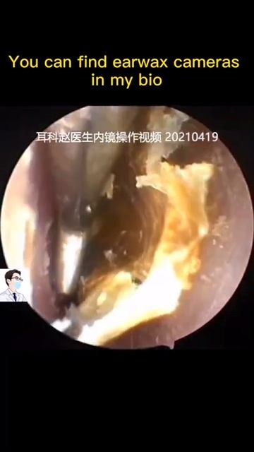 Best Ear Wax Removal & Extraction with Vacuum Remover 真空リムーバーによるにきびの除去と抽出 8 смотреть онлайн