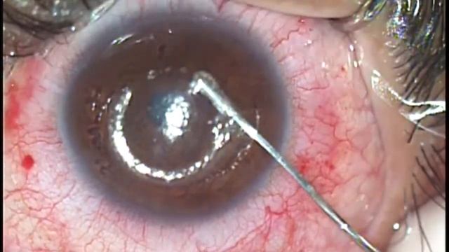 Post Lasik Ectasia - Intrastromal CXL and RING - Dr. Bernardo Moscovici смотреть онлайн