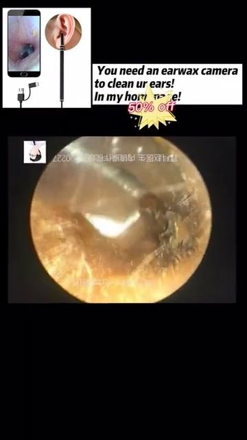 Best Ear Wax Removal & Extraction with Vacuum Remover 真空リムーバーによるにきびの除去と抽出 285 смотреть онлайн