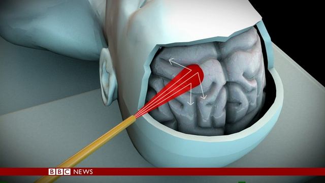 Laser detects brain tumour during surgery - BBC News смотреть онлайн