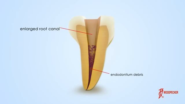 Woodpecker TIPS E1 смотреть онлайн