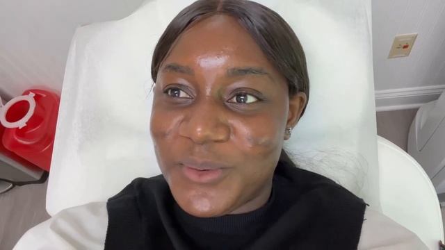 First ResurFx Laser treatment (My tribal mark removal journey )with @janjuafacialsurgery смотреть онлайн