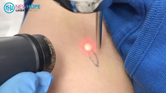 Laser Tattoo Removal - Removing a line tattoo - Newhope Laser Skin Care - Orange County смотреть онлайн