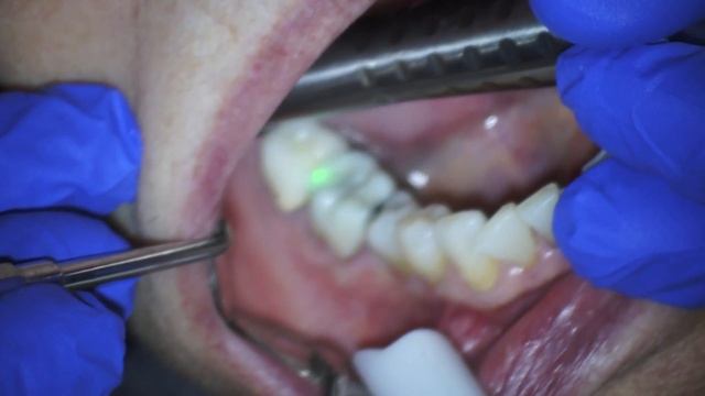 Fotona Erbium Laser Zirconia or Porcelain Crown Removal смотреть онлайн