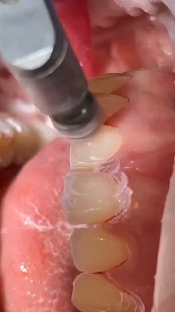 Как проходит чистка зубов ? смотреть онлайн