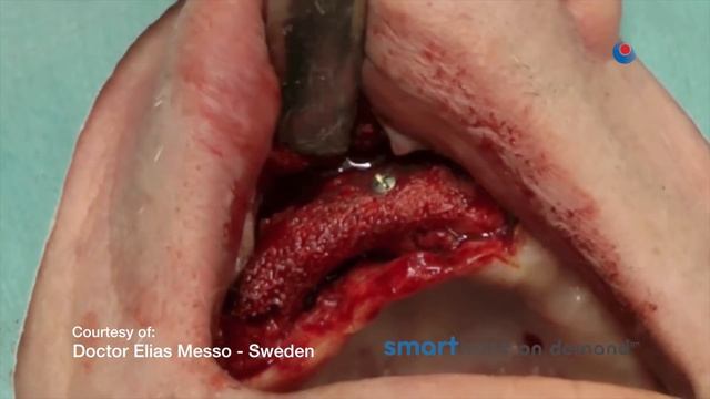 SmartBone on Demand Case by Dr. E. Messo (Sweden) - Highlights @ DUBAI AEEDC 2013 смотреть онлайн