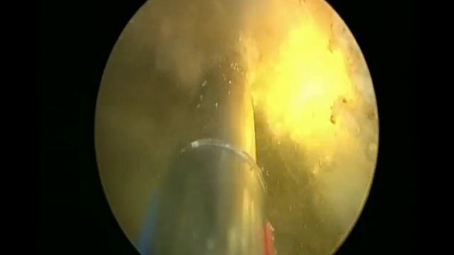 Anatomic PVP with the GreenLight XPS 180 watt laser смотреть онлайн