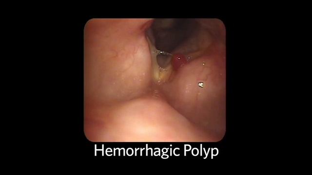 AAO-HNSF The ENT Exam Episode 4: The Nasopharynx and Larynx Exam смотреть онлайн