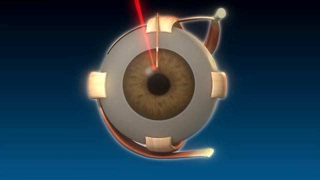 Laser turns brown eyes blue смотреть онлайн