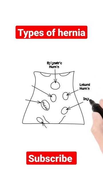 Types of hernia@goodmedicine5056 @GoodMythicalMorning смотреть онлайн