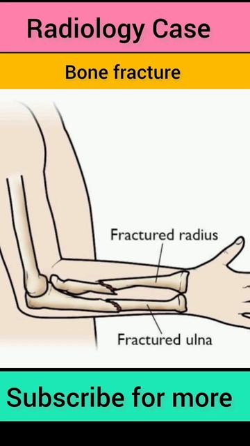 #radiology #radiographer #radio #bone #fracture #xray #xrays #radiography #trendingshorts #trending смотреть онлайн