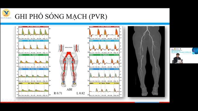 Các phương pháp chẩn đoán bệnh động mạch ngoại biên смотреть онлайн