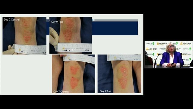 Medihoney – Healing is Believing, Webcast Sponsored by Integra смотреть онлайн