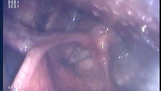Endoscopic Laryngeal Video Stroboscopic Exam смотреть онлайн