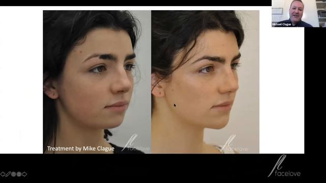 Lip Enhancement and cheek with dermal fillers - Facelove Medispa Mike Clague Aesthetic Nurse BSC - смотреть онлайн