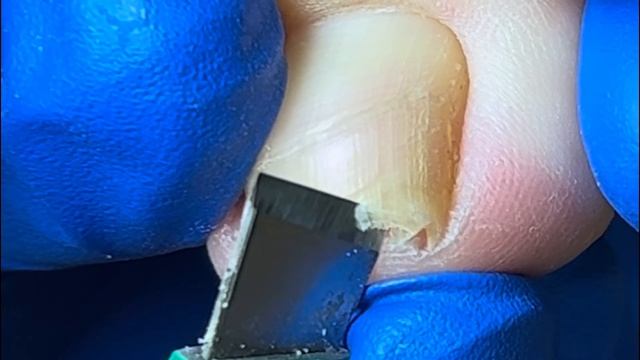 Solve Ingrown Toenails Easily! Professional Pedicure【Xue Yidao Pedicure】