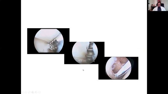 Les tendinopathies de l'épaule, Dr Damien Lami смотреть онлайн