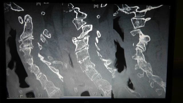 Spine Conference Downs Syndrome Cervical Stenosis