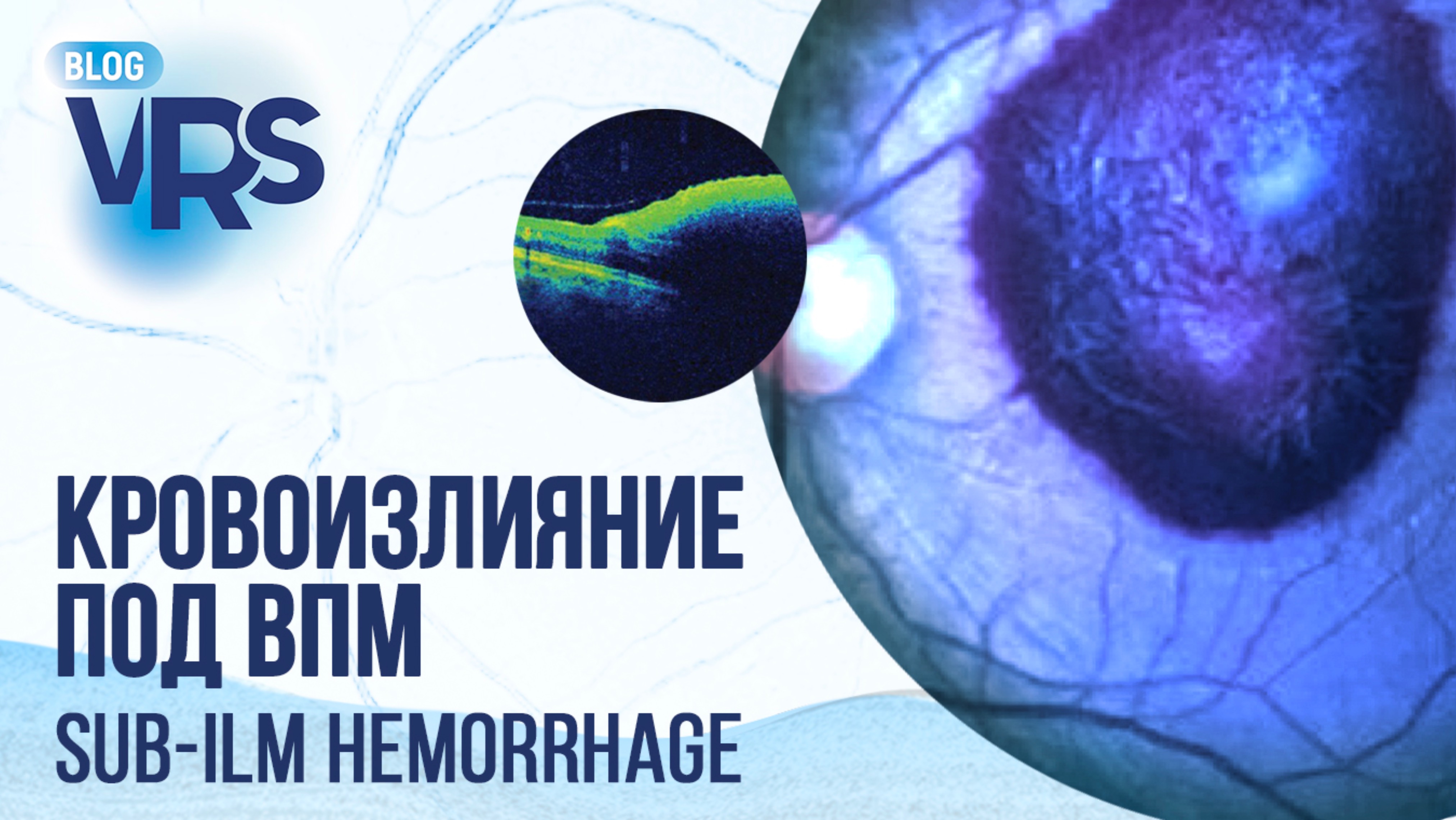 Кровоизлияние под внутреннюю пограничную мембрану | Sub-ILM Hemorrhage