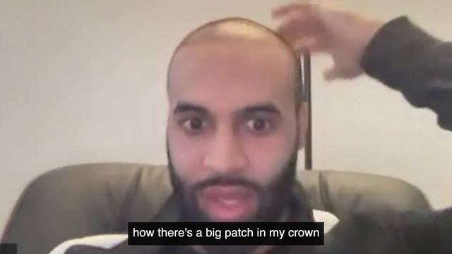 I SHAVED MY HEAD BALD 4 YEARS POST HAIR TRANSPLANT смотреть онлайн
