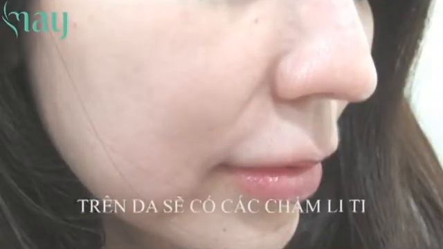 FOTONA 4D TRẺ HÓA DA (REVIEW KHÁCH HÀNG MAY BEAUTY CENTER) смотреть онлайн