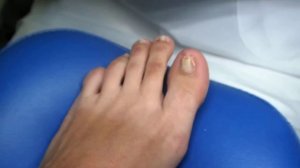 Установка B/S пластины для коррекции ногтя | Способ коррекции вросшего ногтя