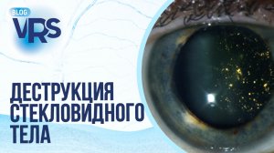 Деструкция стекловидного тела. Нужно ли оперировать? Мнение иностранных коллег.