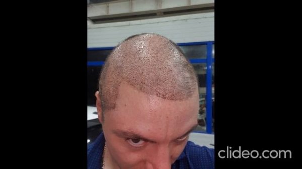 Пересадка  волос  1 до 15 дня  Фото