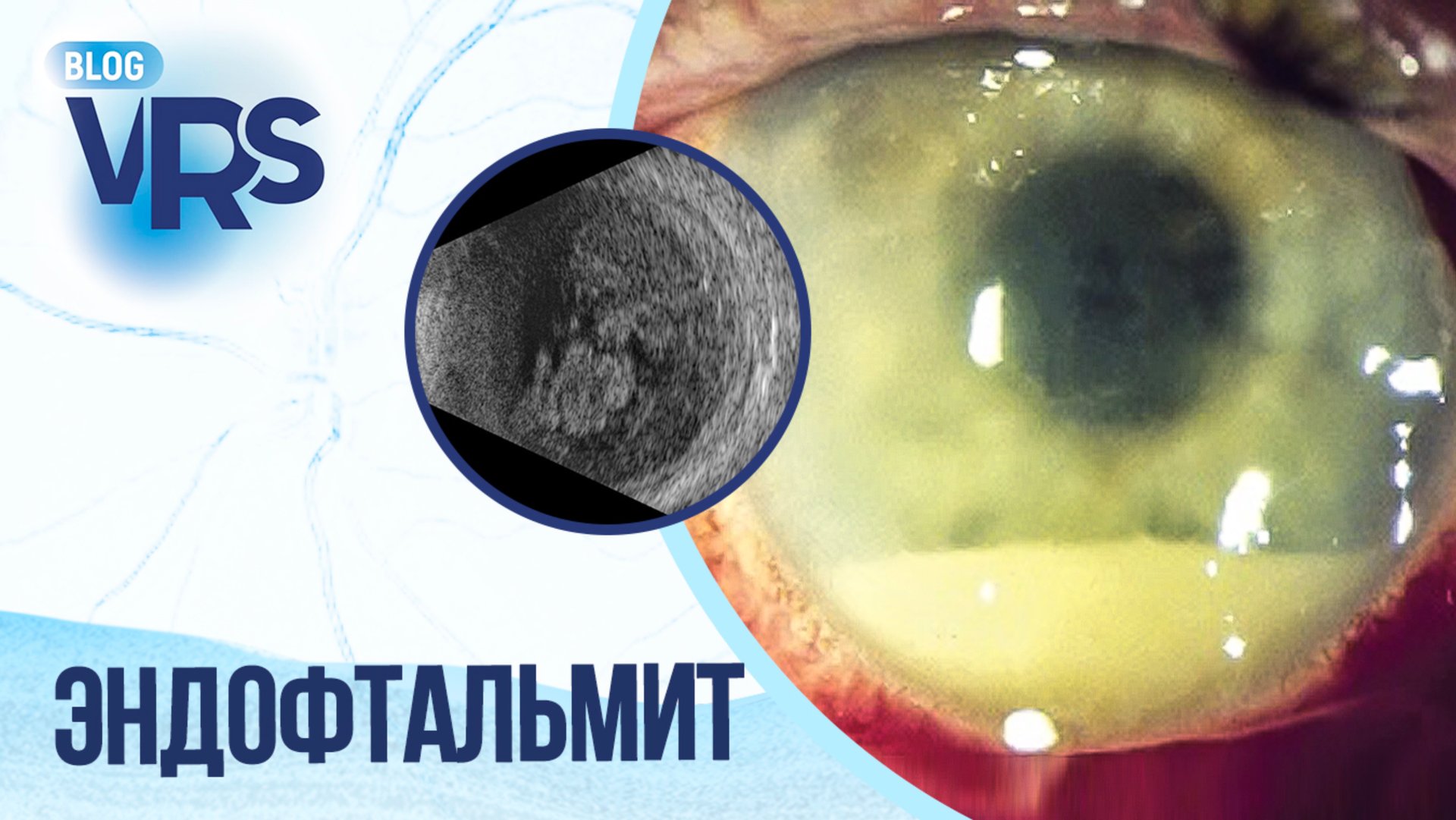 Эндофтальмит | Эндогенный и послеоперационный