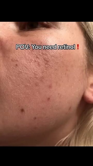 Do you NEED TO START RETINOL ALREADY?!! #skincareroutine #skincare смотреть онлайн