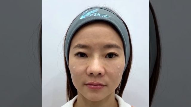 Xóa Nhăn Trán, Nhăn Ấn Đường Phong Thủy Không Tốt Chỉ 60 Phút Bằng Công Nghệ Mono RF tại Cihan смотреть онлайн