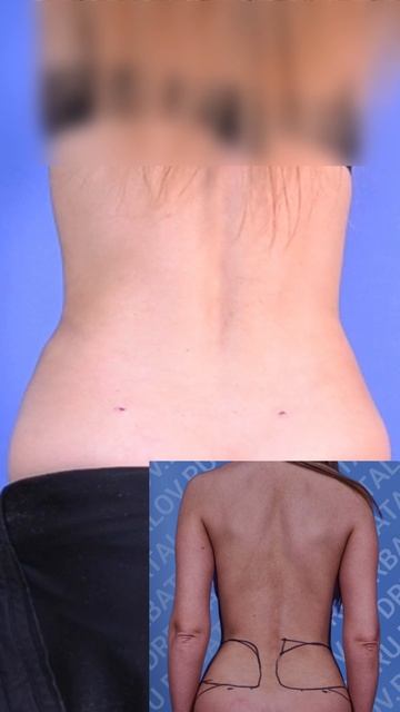 Липосакция для худых