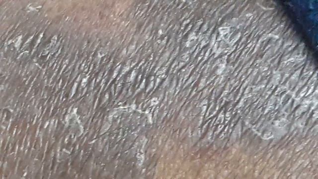 Tinea Corporis смотреть онлайн
