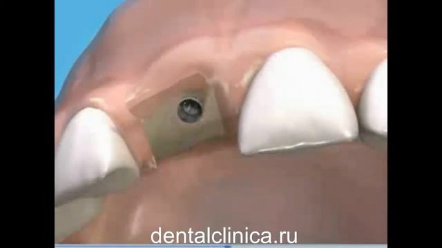 European Clinic of Aesthetic Dentistry Имплантация протезирование пластическая хирургия ортодонтия смотреть онлайн